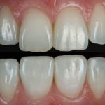 The Art of Smile Symmetry in Composite Bonding