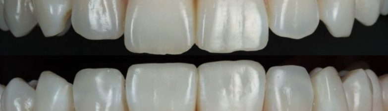The Art of Smile Symmetry in Composite Bonding