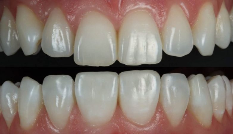 The Art of Smile Symmetry in Composite Bonding