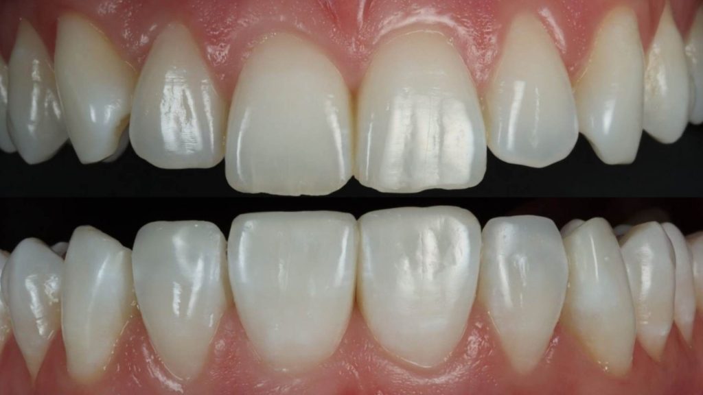 The Art of Smile Symmetry in Composite Bonding