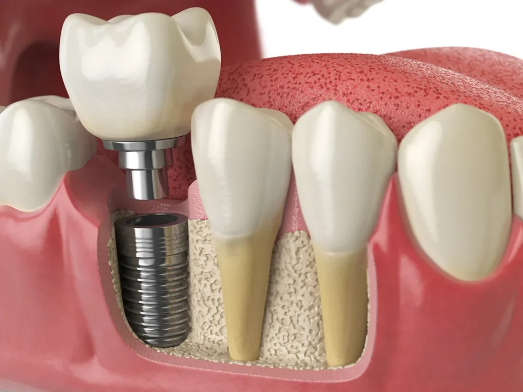 The Art and Science of Designing Perfect Smiles with Dental Implants
