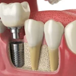 The Art and Science of Designing Perfect Smiles with Dental Implants
