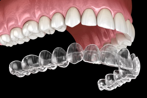 Invisalign: Unveiling the Connection Between Clear Aligners and Speech Clarity