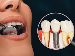 The Psychological Impact of Replacing Missing Teeth with Permanent Dental Implants