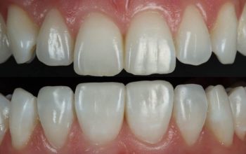 The Art of Smile Symmetry in Composite Bonding