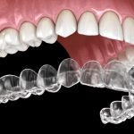 Invisalign: Unveiling the Connection Between Clear Aligners and Speech Clarity