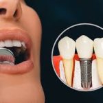 The Psychological Impact of Replacing Missing Teeth with Permanent Dental Implants