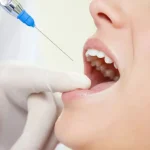 How Botox Reshapes Dentists' Approach to Treating Orofacial Muscle Disorders